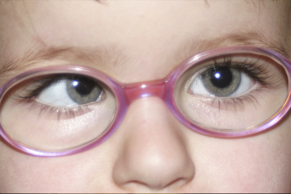 UNDERSTUNDING STRABISMUS