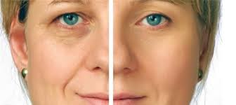 BLEPHAROPLASTY. WHAT IS IT AND WHAT IS IT FOR.