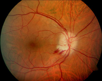 This image show lineal hemorage in the retina,very tipical sign of a AION