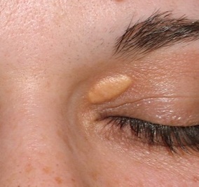 XANTHELASMA IN EYELIDS, INCREASED RISK OF HEART ATTACK