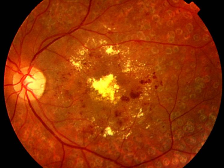 diabetic retinopathy ocular clinic marbella