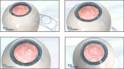 icl-lens-marbella-clinic-ocular-surgery-carreterocarretero
