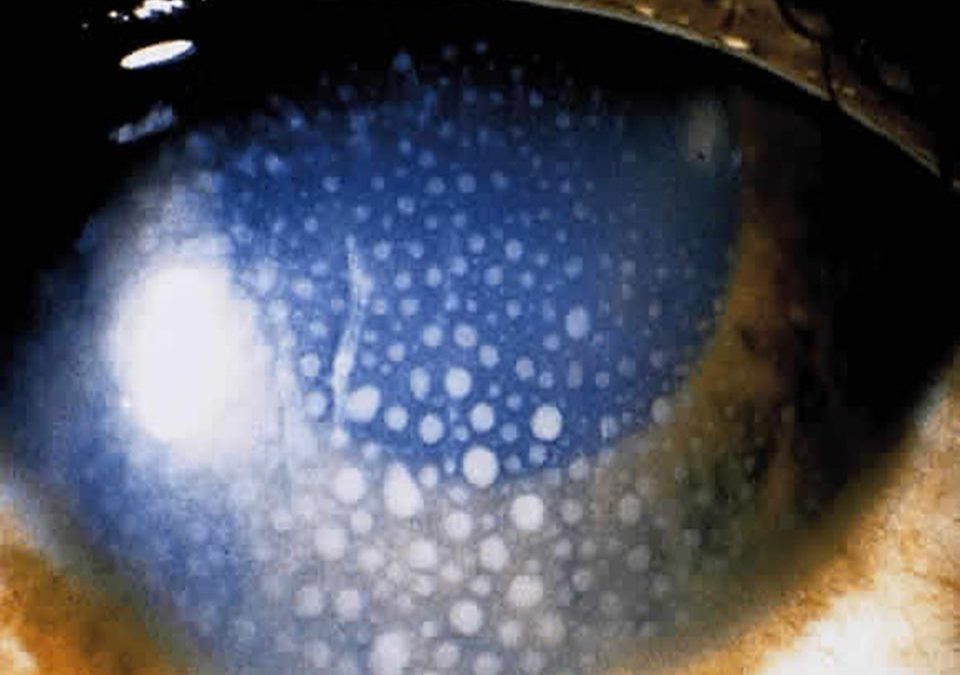 PREVIOUS UVEITIS. WHAT IS AND HOW  TO TREATED IT