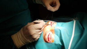 eyelid-surgery-marbella