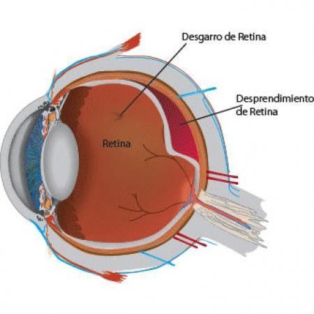 WHAT DO YOU KNOW ABOUT THE RETINAL DETACHMENT?