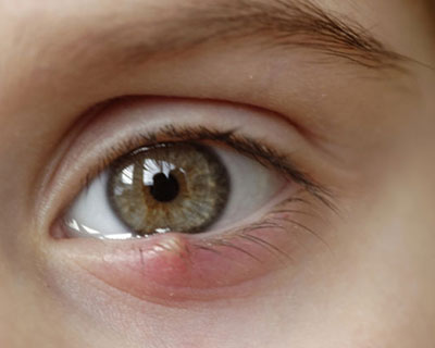 CHALAZION: CAUSES AND TREATMENT