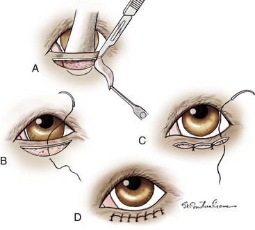 MOST FREQUENTE TECHNIQUE PRACTICE FOR EYELID SURGERY 2