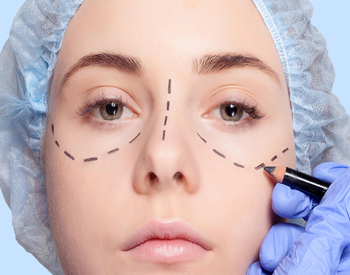 blefaroplastia-marbella